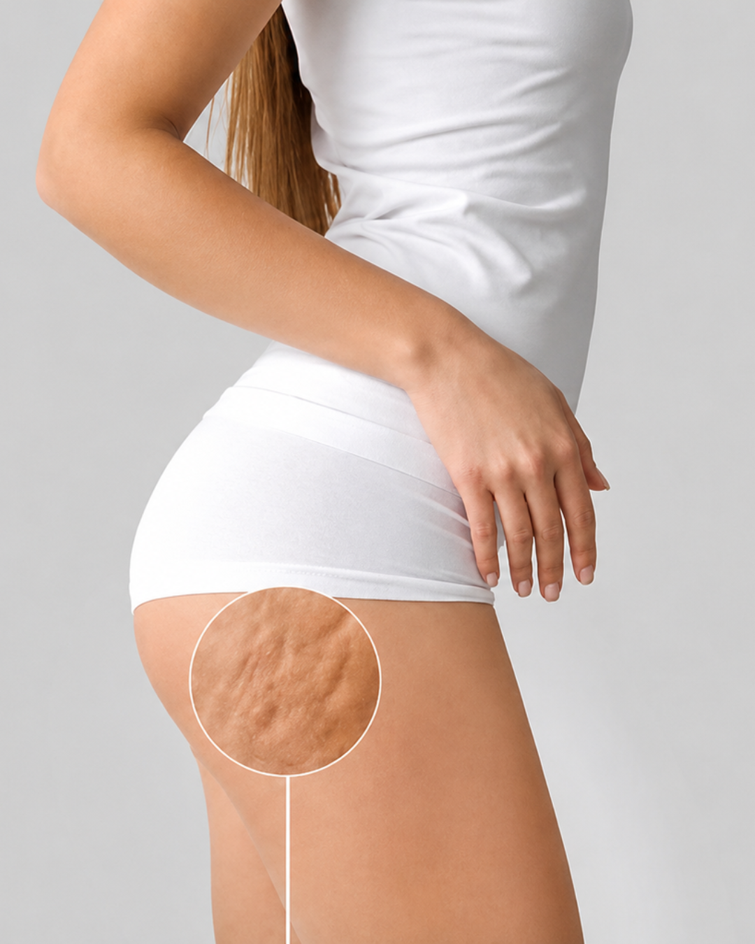 Celulitis Edematosa: Qué es y Cómo Combatirla