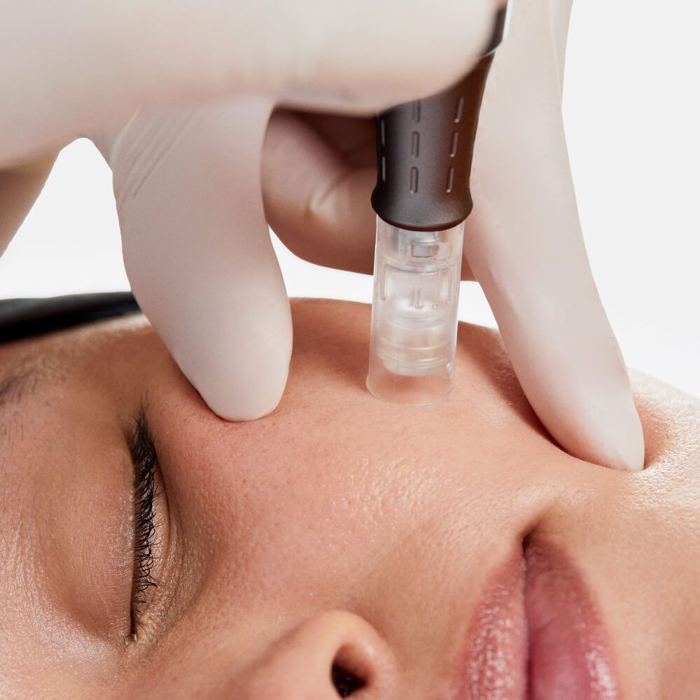 Mesoterapia con Dermapen: potenciando la absorción de vitaminas y colágeno.