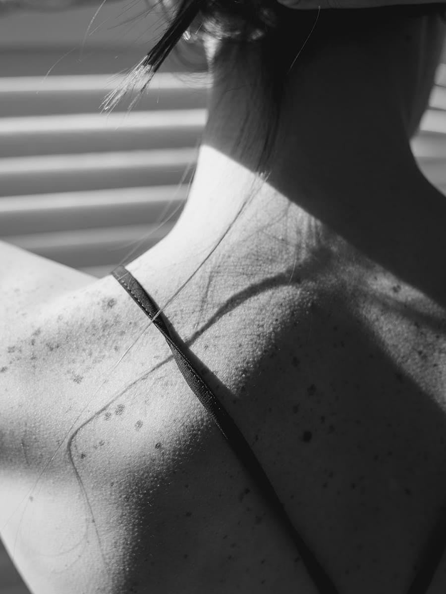 Lentigos Solares: Cómo Identificarlos y Eliminar las Manchas de la Edad
