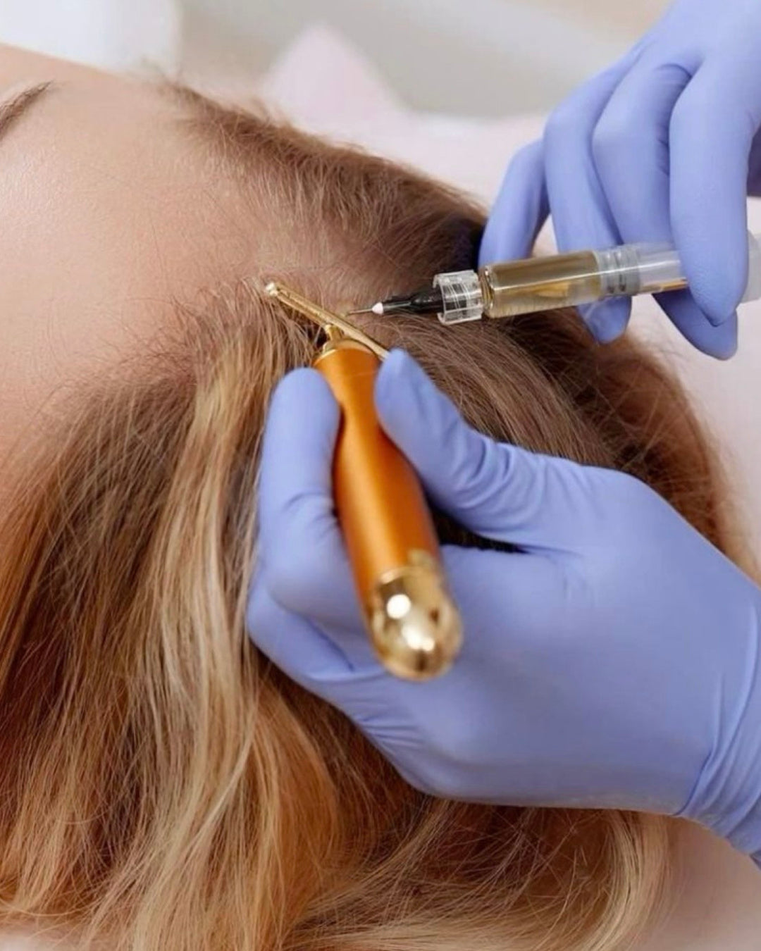 ¿Qué es el PRP Capilar? Beneficios y cómo funciona el tratamiento con plasma para el cabello