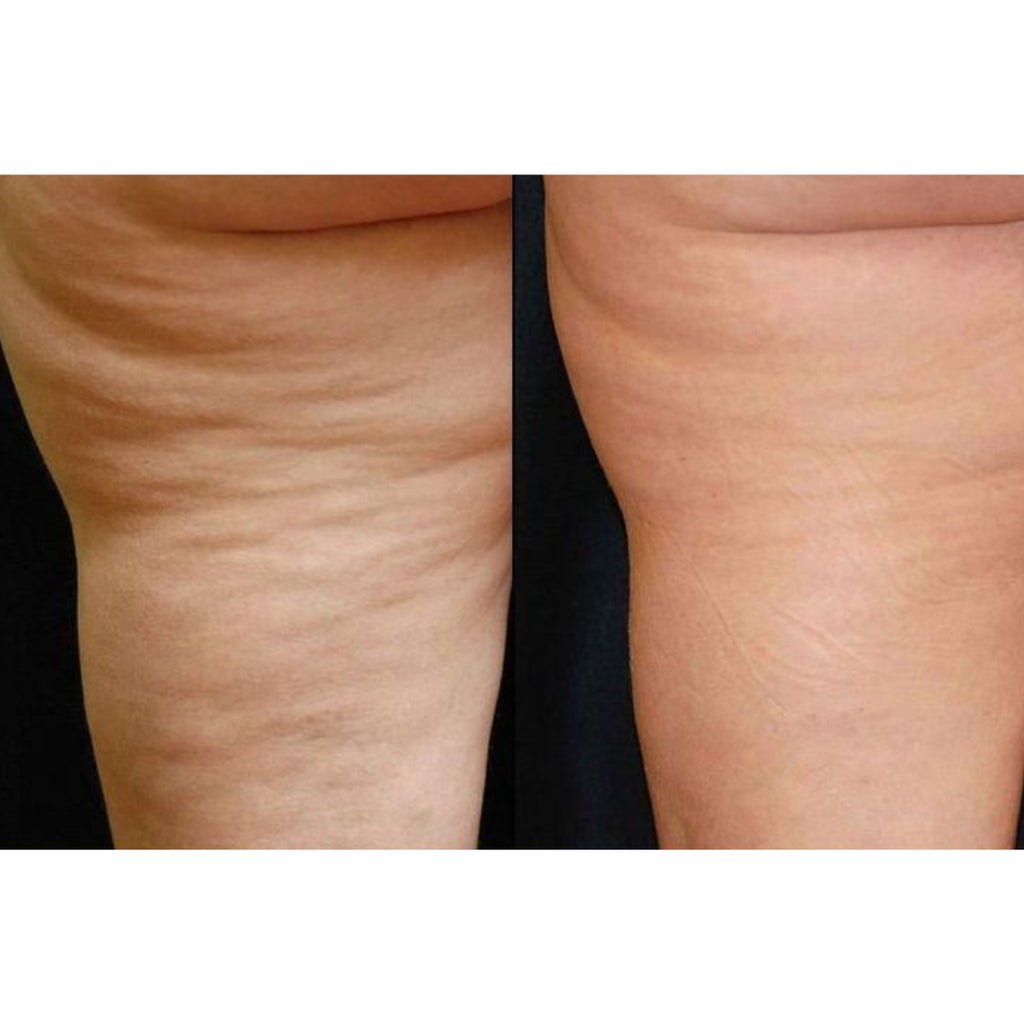 ReshapeX Corporal - Alma Primex