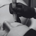 Facial dermapen