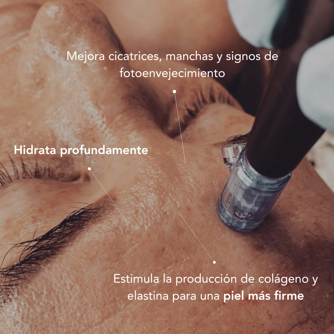 Tratamiento Facial Exosomas Dermapen