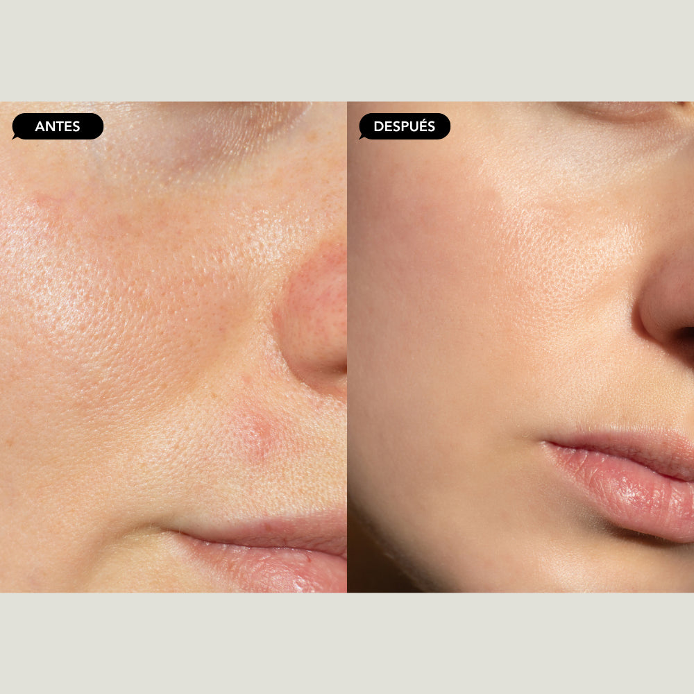 Indiba instant beauty