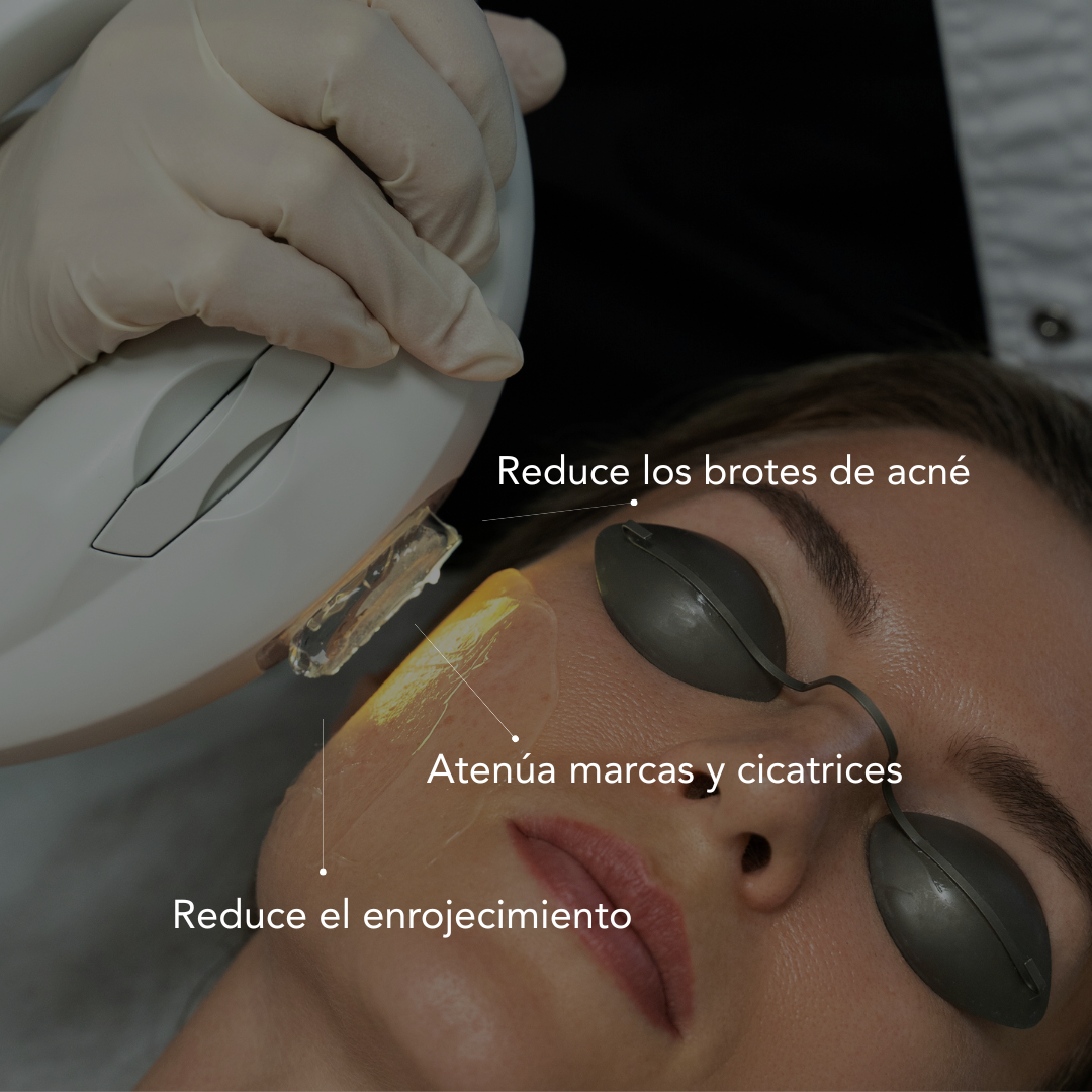 IPL Anti-Imperfection Treatment