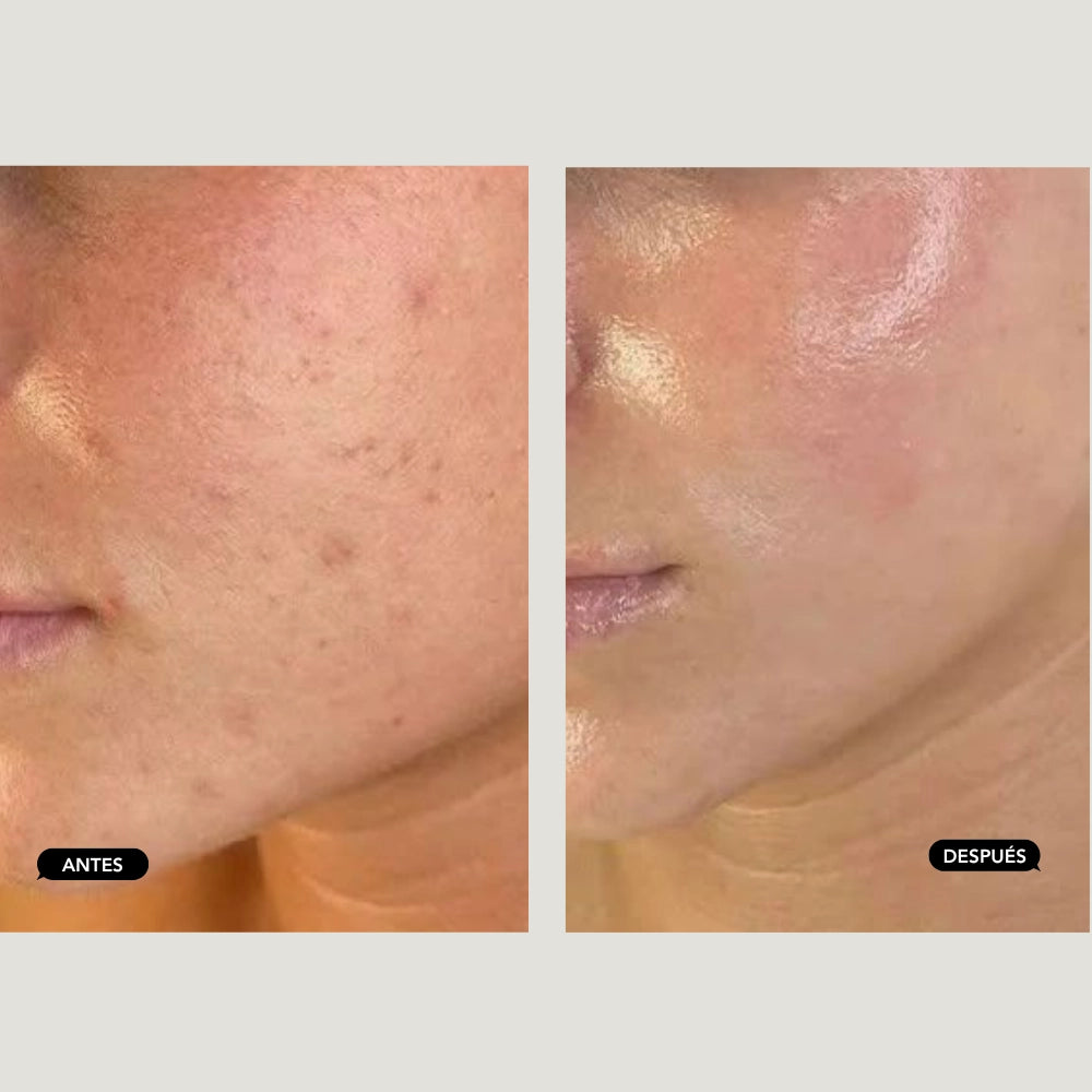 IPL Anti-Blemish Treatment