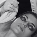IPL Anti-Blemish Treatment