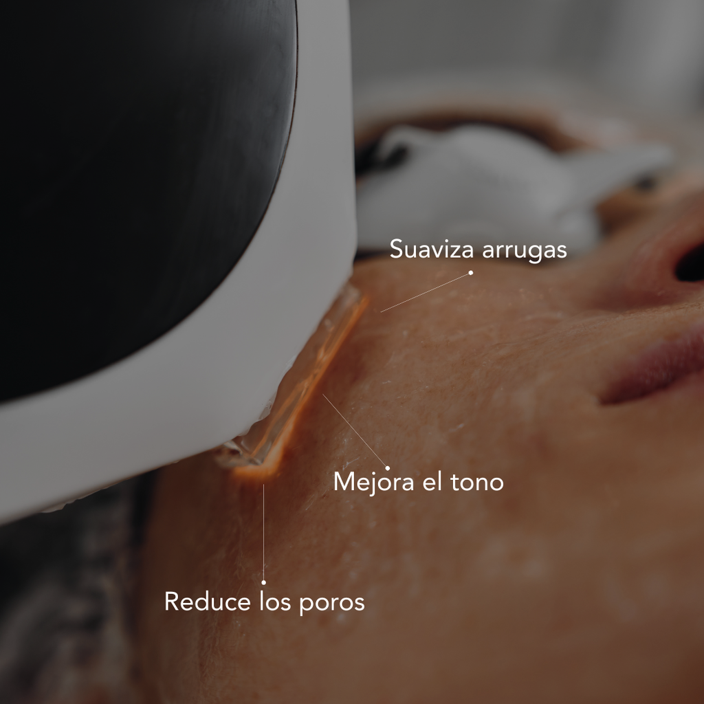 Traitement de rajeunissement par lumière pulsée intense (IPL)