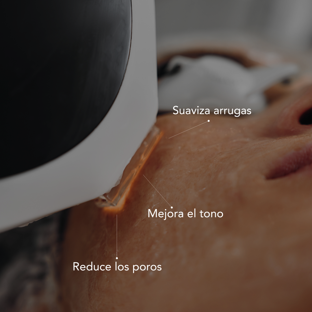 Traitement de rajeunissement par lumière pulsée intense (IPL)