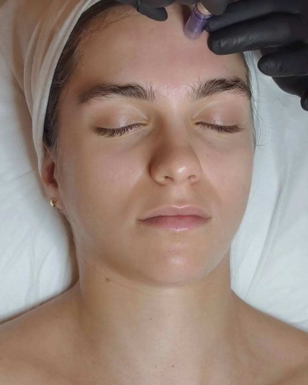 Tratamiento Facial Exosomas Dermapen