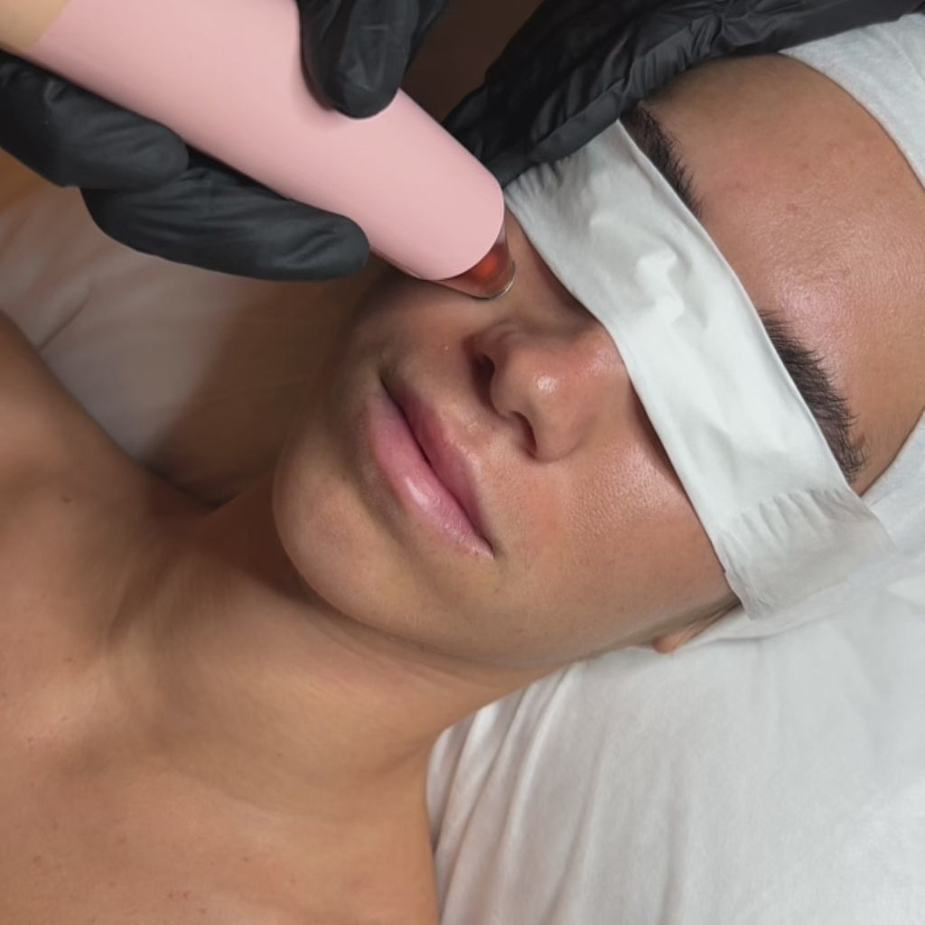 Microdermabrasion