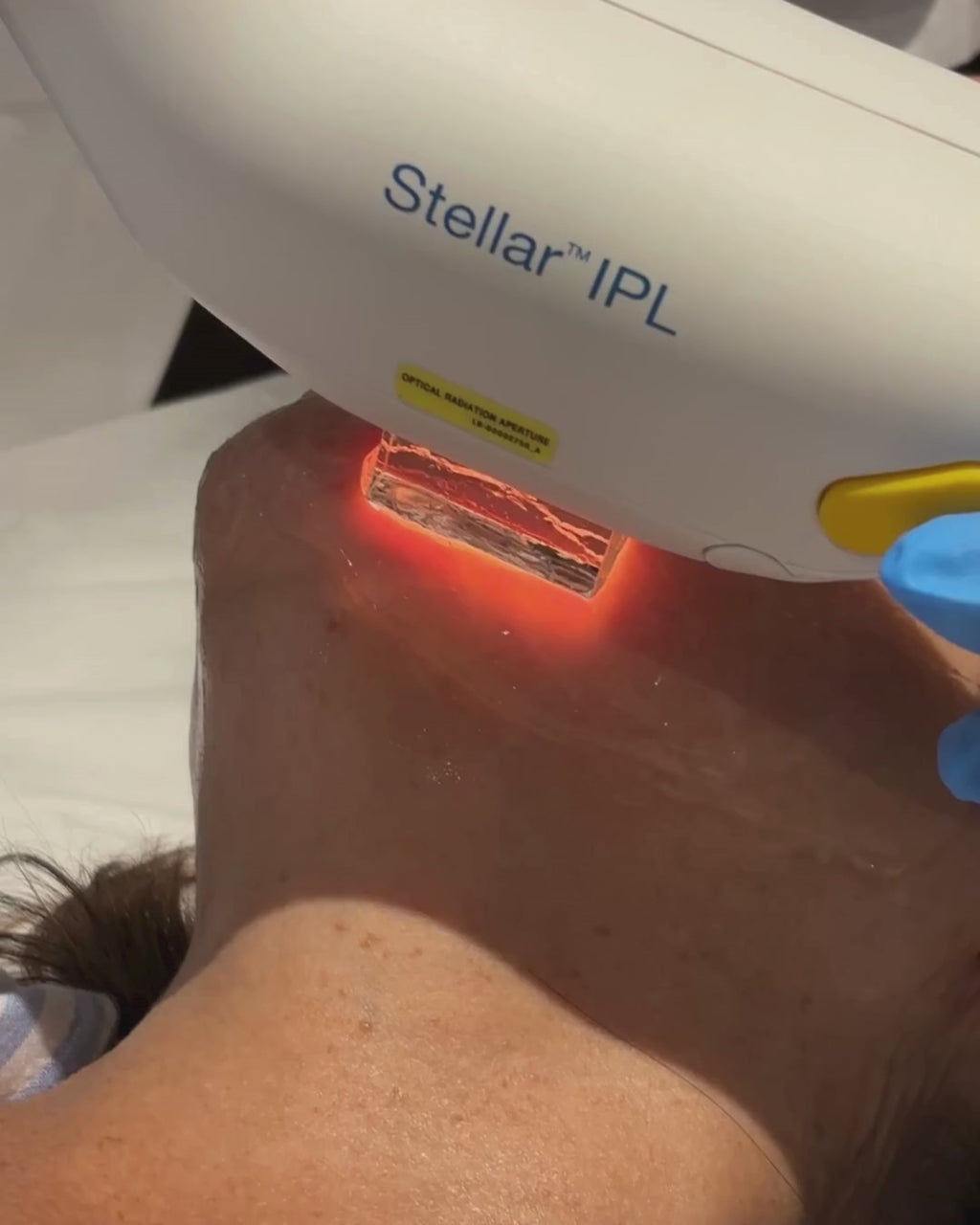 Traitement anti-imperfections par lumière pulsée intense (IPL)
