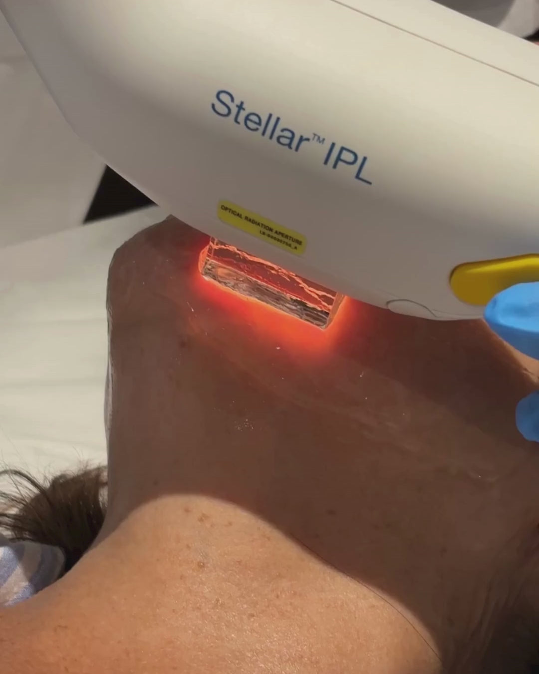 IPL Anti-Imperfection Treatment