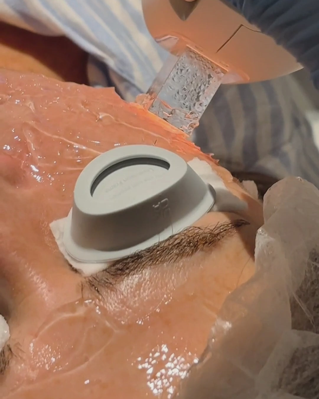 IPL Anti-Blemish Treatment